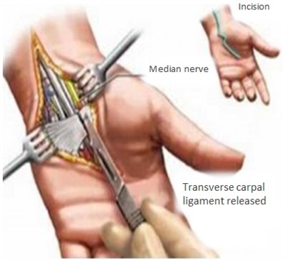3-Image-CTS-Treatment-Transverse carpal ligament released